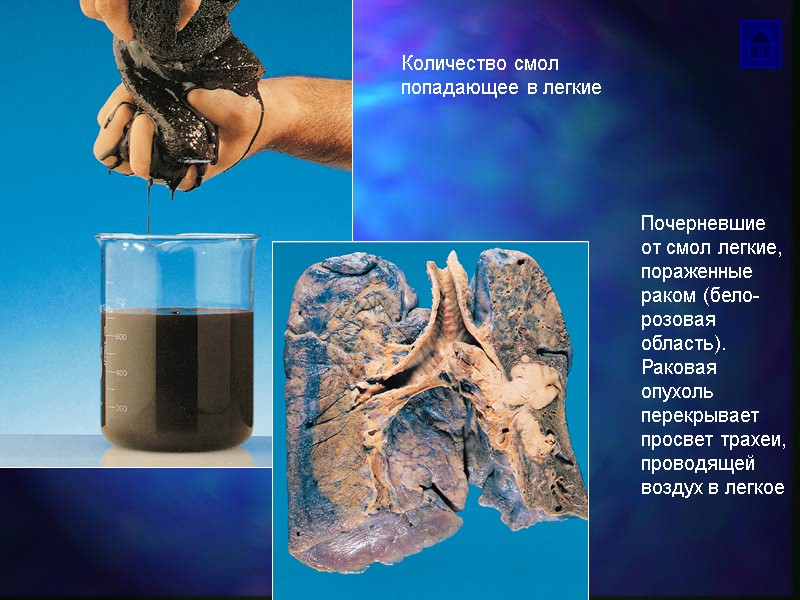 Количество смол попадающее в легкие Почерневшие от смол легкие, пораженные раком (бело-розовая область). 